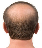 Hair Transplantation