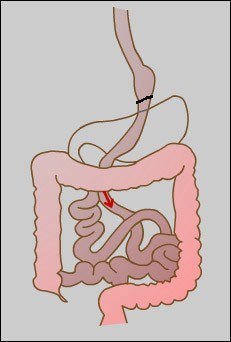 Gastric Bypass