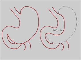 Sleeve Gastrectomy